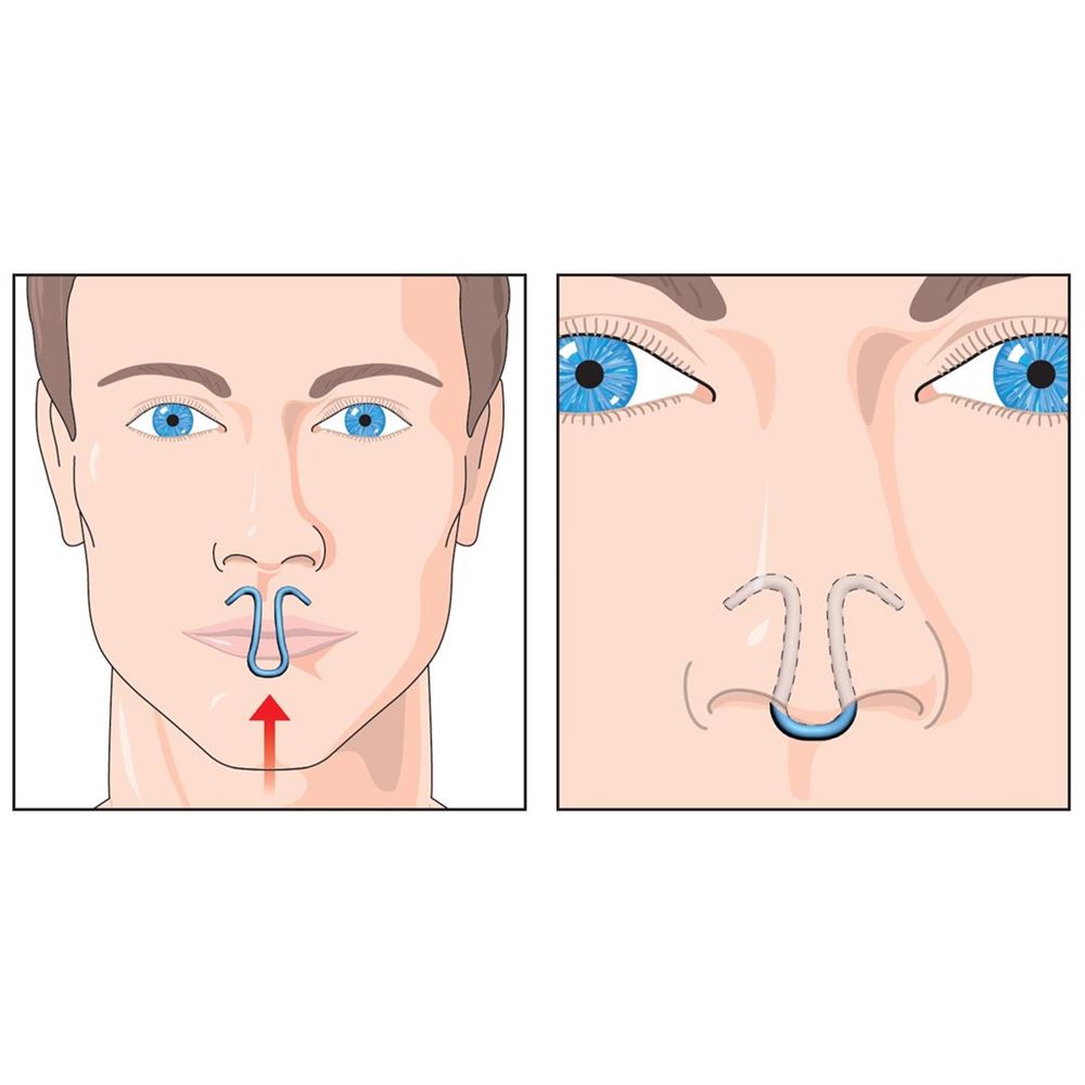 CLIPAIR dilatateur nasal, image 4 sur 4