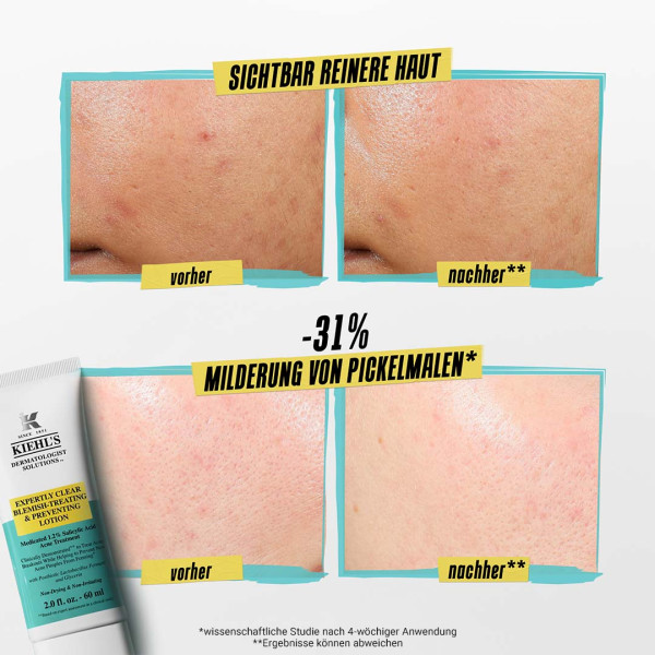 KIEHL'S Acne Treatment, image 3 sur 4
