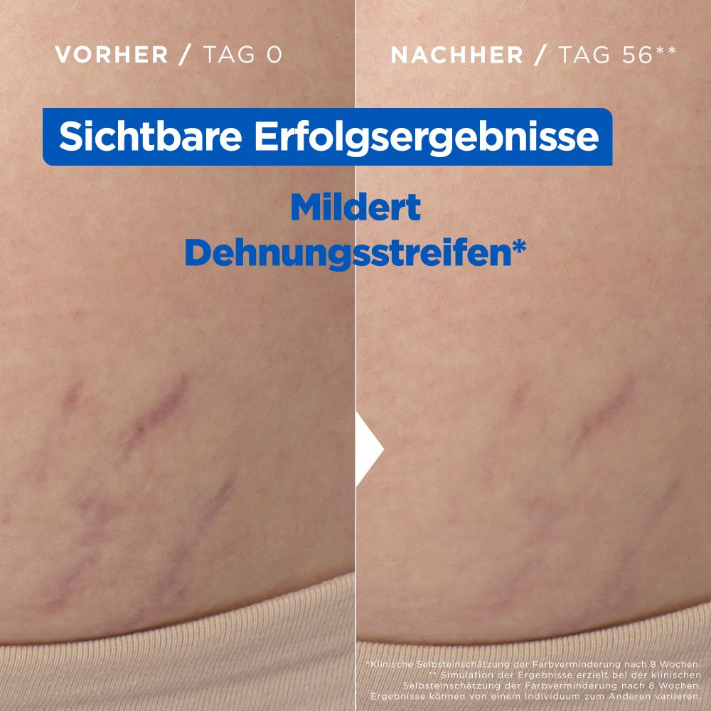 MIXA Niacinamide Stretchmark Oil, Bild 5 von 5