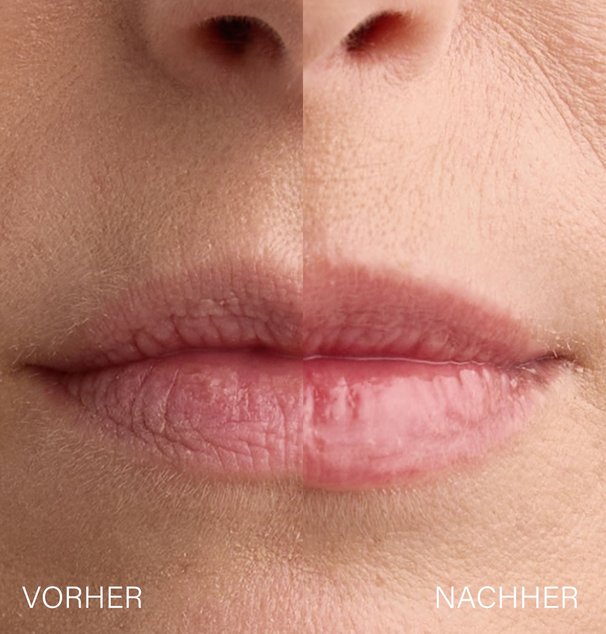 ROSENTAL Lip Plumper, Bild 3 von 5
